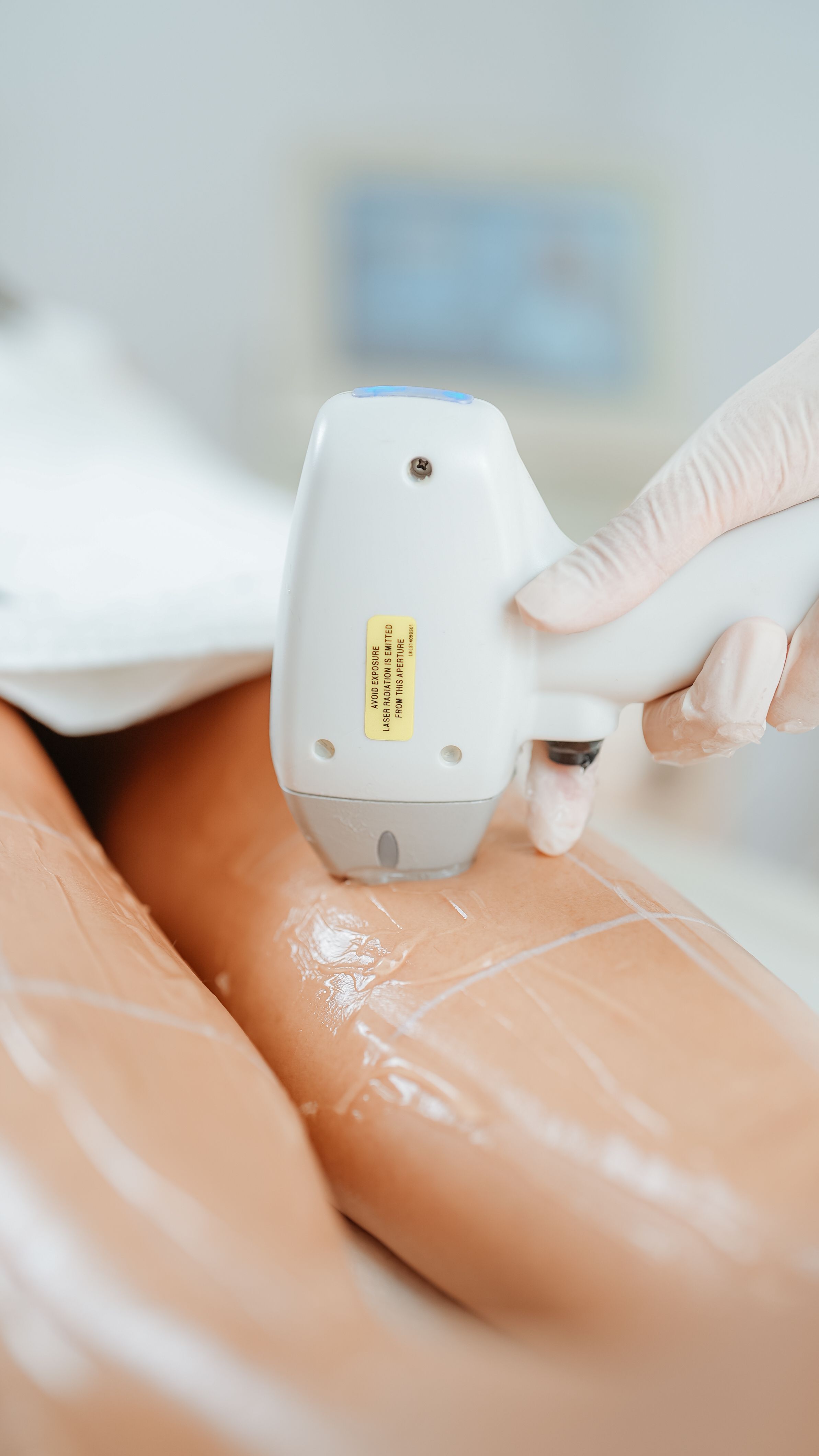 Laser Hair Removal