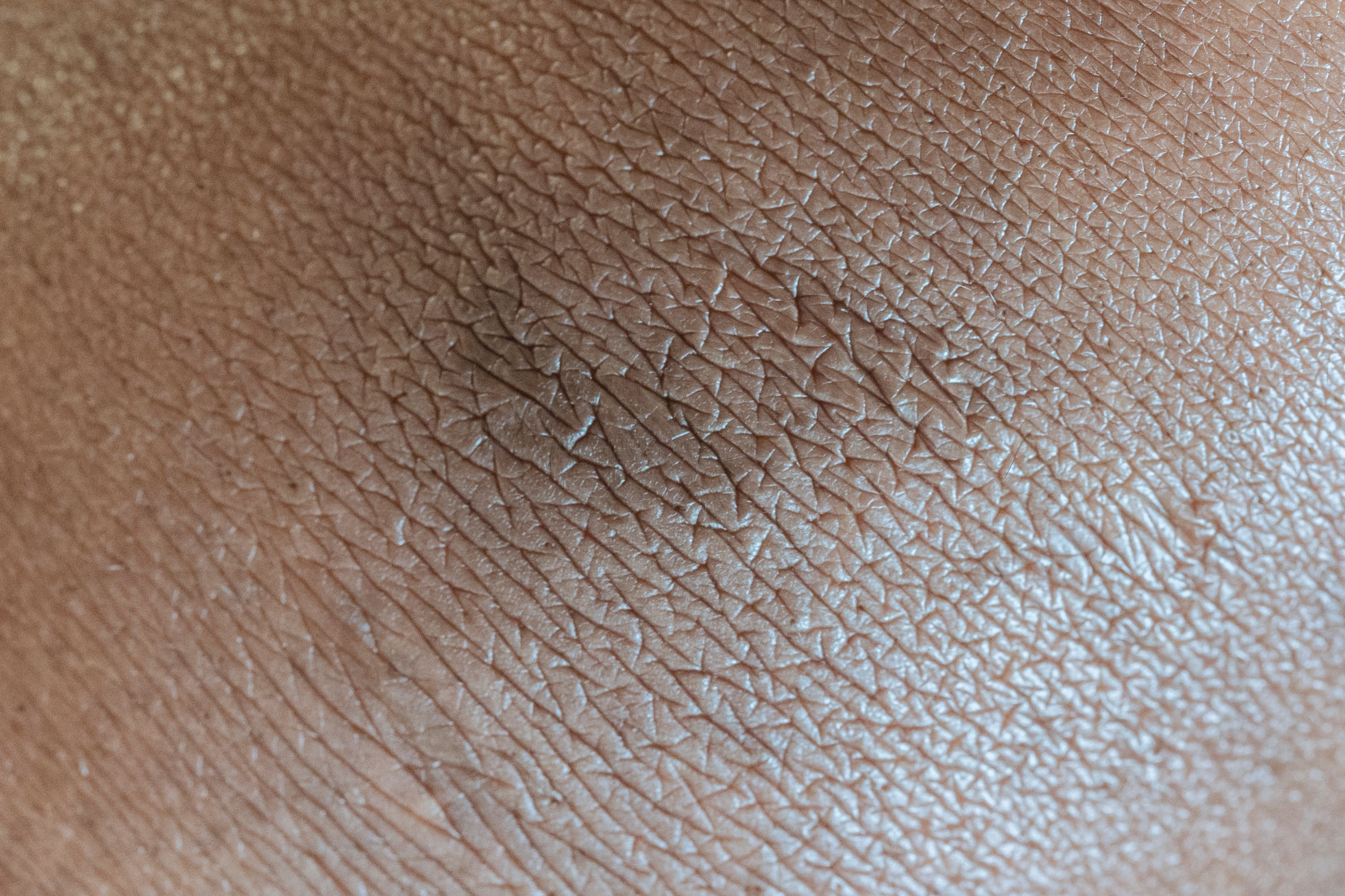 Skin Tags & Moles Removal